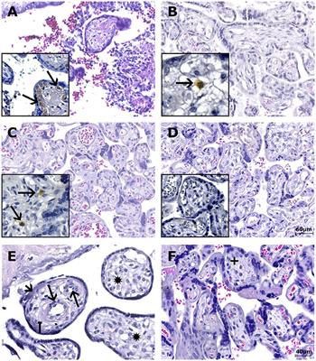 Zika Virus Infection at Different Pregnancy Stages: Anatomopathological Findings, Target Cells and Viral Persistence in Placental Tissues